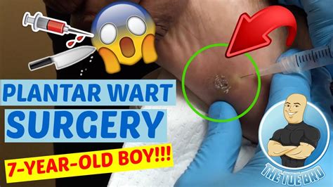 HUGE WART REMOVAL - 7 YEAR OLD FOOT SURGERY!!! - YouTube