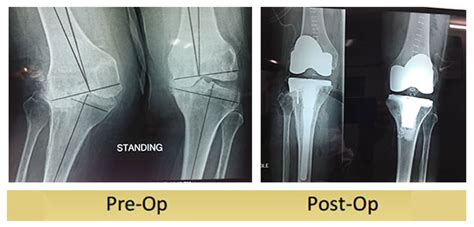 valgus knee total knee replacement sant parmanand hospital