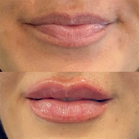 gorgeous lips revive glamour rejuvenation spa facebook