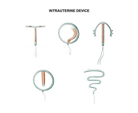 Iud Bleeding After Sex 3 Most Important Reasons