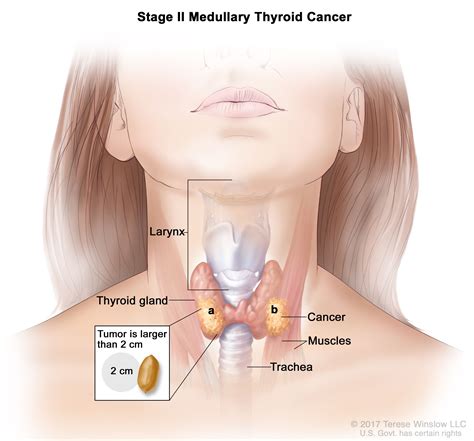 thyroid cancer treatment adult pdq® patient version nci