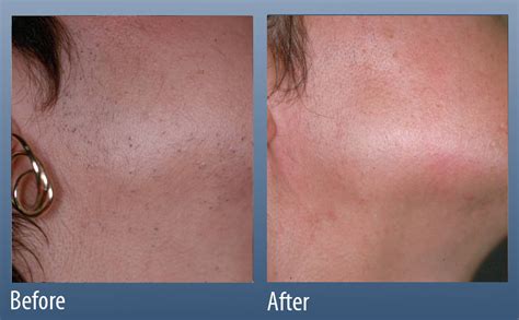 Hair Removal Main Line For Laser Surgery In Ardmore Pa