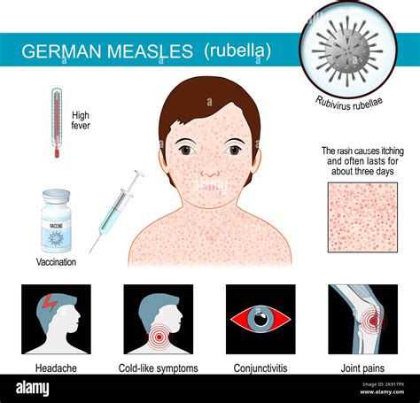 masern  deutschland infografiken zu anzeichen und symptomen von