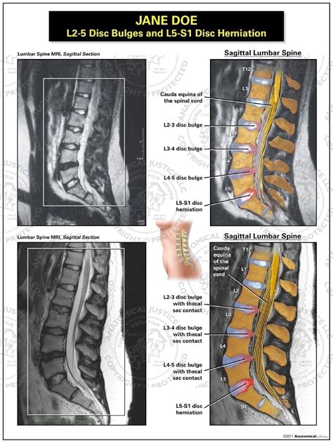 L2 5 Disc Bulges And L5 S1 Disc Herniation