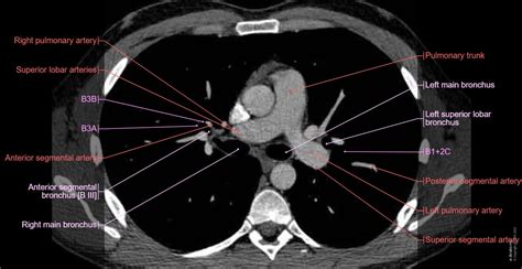 anatomy   lungs mediastinum  heart  axial slice  anatomy