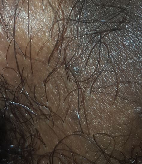 skin tag warts or mole help sexual health forums