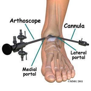 youre   stick  camera    basics  ankle arthroscopy  orthopedics