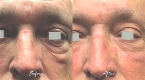 longevity medical aesthetics laser clinic fotona smootheye