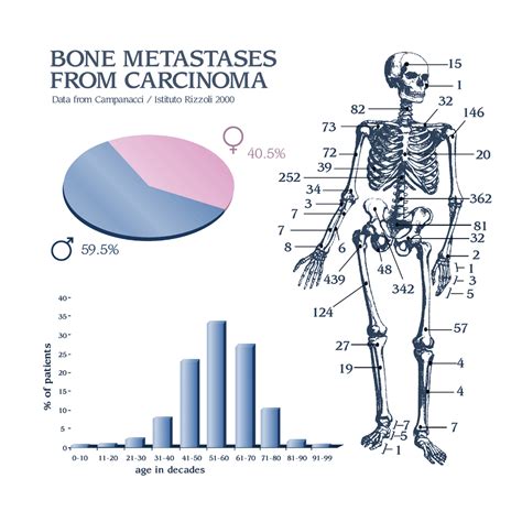 metastatic prostate cancer bonetumororg