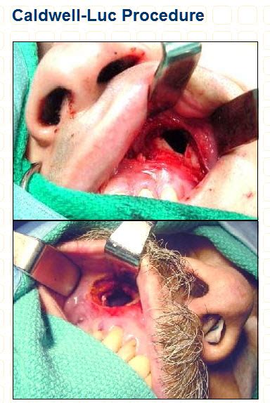 Root canal and sinus polyps