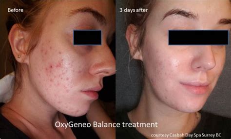 oxygeneo facials true essence skin and laser med spa