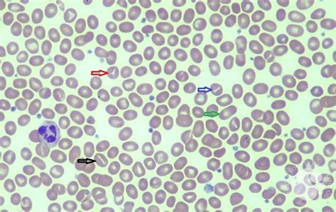 south east asian ovalocytosis 3