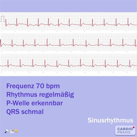 normaler puls sinusrhythmus smartphone ekg routinemessung