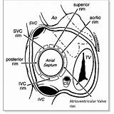 Rims Atrial Septum Atrium Svc Ovale Foramen Pfo Indicates Closure Ivc Aorta Echocardiogram Intracardiac Vena Cava Disorders Tunnel sketch template