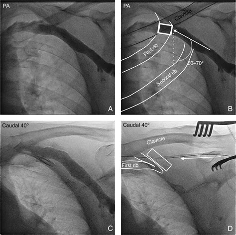 Caudal Fluoroscopy To Guide Venous Access For Pacemaker Device