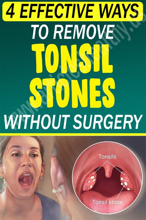 effective ways  remove tonsil stones  surgery