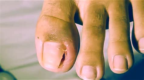 toenail cut massive video cut nail youtube