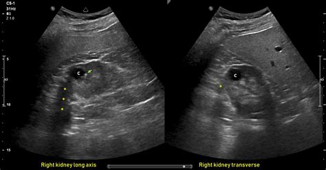 ultrasound features  kidney cysts renal fellow network