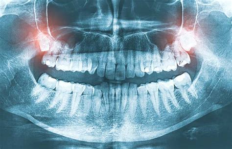Common Signs To Get Wisdom Teeth Removed Absolute Dental