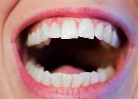 tooth decay  crown oral health