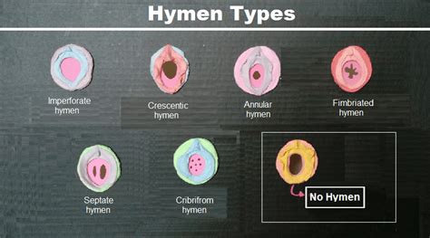 Hymen Types Shapes And Sizes Helal Medical