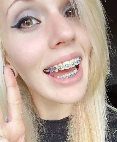 Braces Braceface Metalbraces Girlswithbraces Elastics Cute Girls