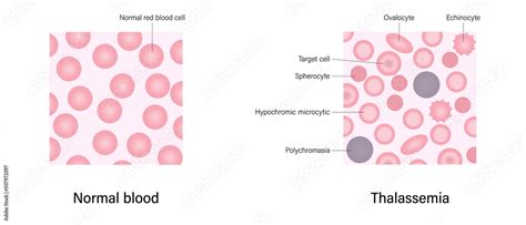 thalassemia blood smear  difference  thalassemia  normal blood