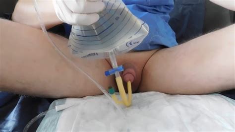 Filling The Bladder With An Inserted Catheter Ch 28fr Xxx Mobile