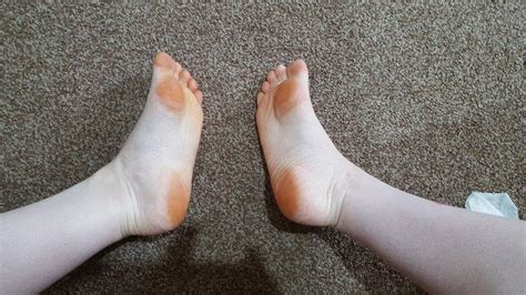 orange feet babycentre