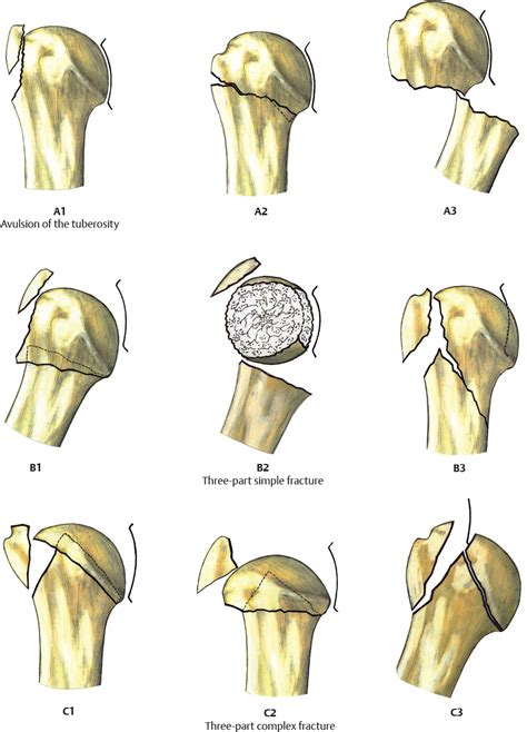 Ao Asif Fracture Classification Plastic Surgery Key