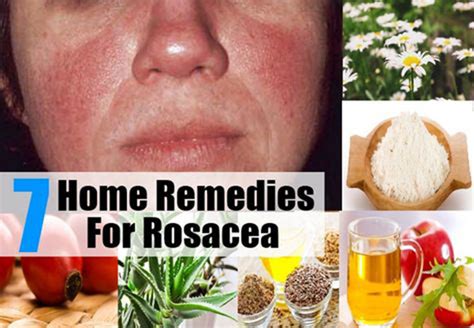 amazing rosacea home remedies  treatments