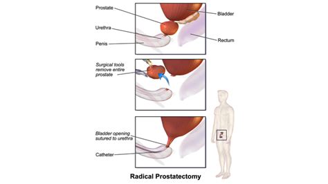 Prostate Gland Removal