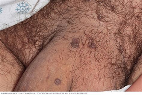can anal warts cause cancer excellent porn