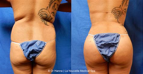 brazilian butt lift before and after photos ventura