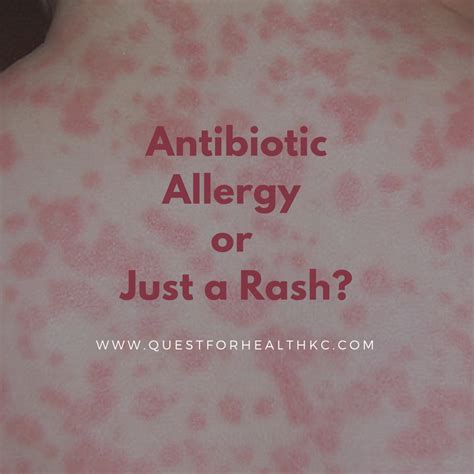 Аллергия Антибиотики Сыпь На Коже Telegraph