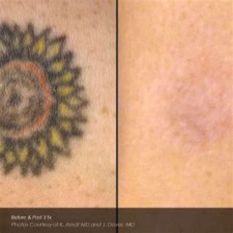 laser tattoo removal affordable tattoo removal melbourne