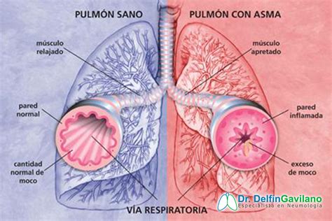 asma neumologos en lima especialista en neumologia medico neumologo