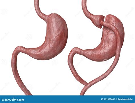 gastric bypass   type  bariatric surgery  consists  reducing  stomach  altering
