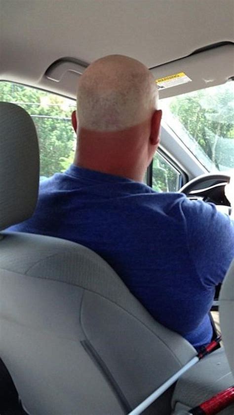 ouch 19 of the worst sunburns and tan lines ever