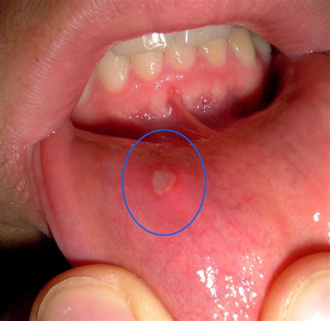mouth sores  symptoms treatment mouth sores
