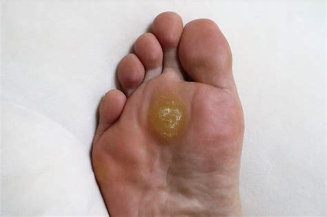 foot corn  callus understanding  differences   skin