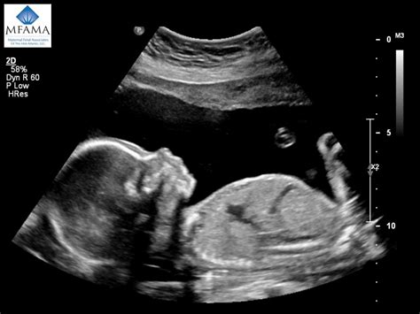 anatomy ultrasound maternal fetal associates   mid atlantic