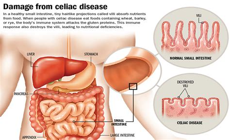 celiac disease diagnosis symptoms treatment diet foods  avoid
