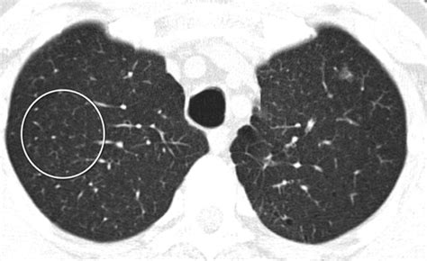 Thin Section Ct Of The Lungs The Hinterland Of Normal Radiology