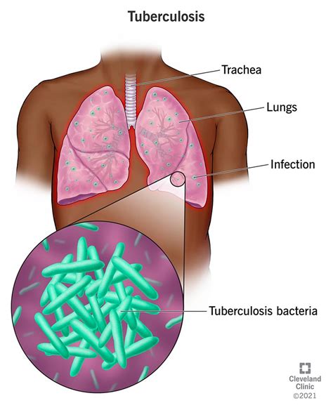 detect tuberculosis netwhile spmsoalan
