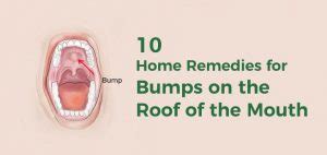 bumps   roof   mouth   effective home remedies