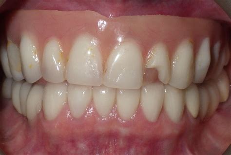 implant dentures grove dental associates