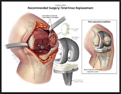 knee replacement  mexico  save  money