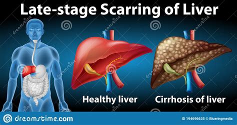 Late Stage Scarring Of Liver Stock Vector Illustration Of Alcoholism