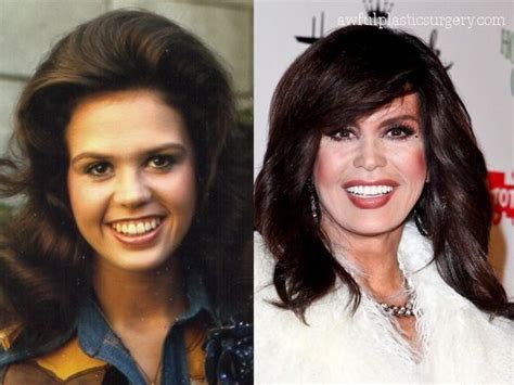 Marie Osmond Before After  575×431 Celebrity